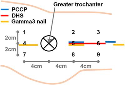 Microcirculation After Trochanteric Femur Fractures: A Prospective Cohort Study Using Non-invasive Laser-Doppler Spectrophotometry